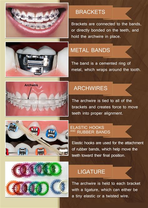 types of rubber bands for braces